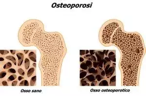 Il calcio non è l'unico elemento importante per la salute delle ossa. Quali altri aspetti nutrizionali sono fondamentali per contrastare l'osteoporosi?